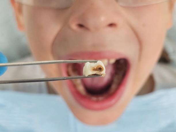 Best Emergency Dental Filling Replacement  in Rutgers University Livingston Campus, NJ